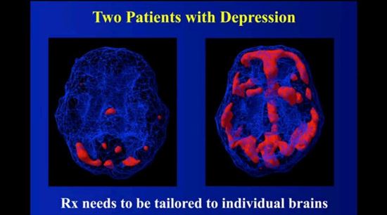 会話だけで「うつ病」と判断されて薬漬けはもう古い！83,000個の脳をスキャンしてわかった精神病の正体
